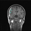 Зона ушиба головного мозга правой лобной и височной долей