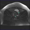 МР- картина  может соответствовать дермойдной кисте левого яичника