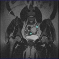 МР- картина  может соответствовать дермойдной кисте левого яичника
