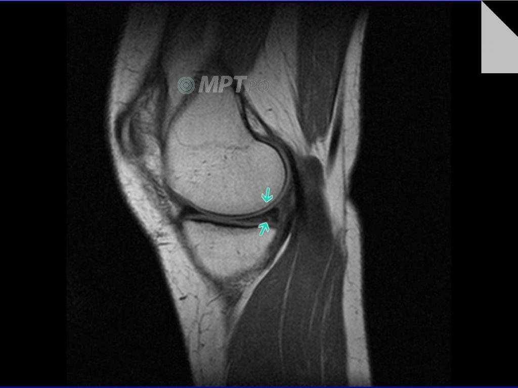 Разрыв заднего рога медиального мениска