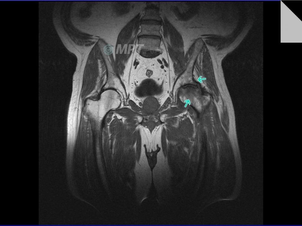 Асептический некроз головки тазобедренной кости